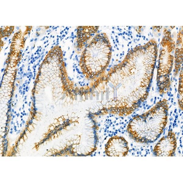 AGR2 Antibody - DF7855 at 1/100 staining Human gastric cancer and adjacent normal tissues by IHC-P.