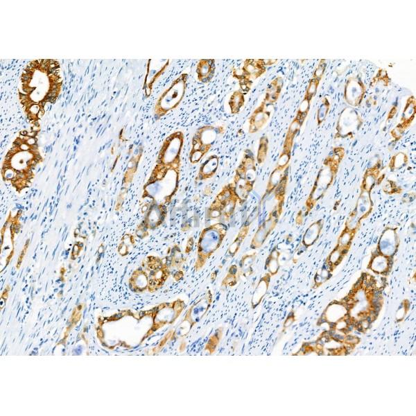 AGR2 Antibody - DF7855 at 1/100 staining Human gastric cancer by IHC-P.