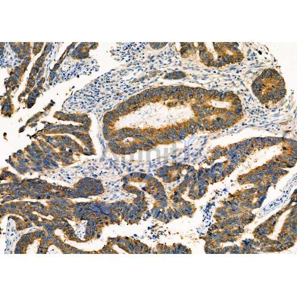 AGR2 Antibody - DF7855 at 1/100 staining Human colorectal cancer by IHC-P.