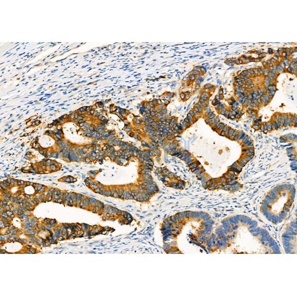 AGR2 Antibody - DF7855 at 1/100 staining Human colorectal cancer by IHC-P.