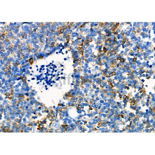 AGR2 Antibody - DF7855 at 1/100 staining Human pancreatic cancer by IHC-P.