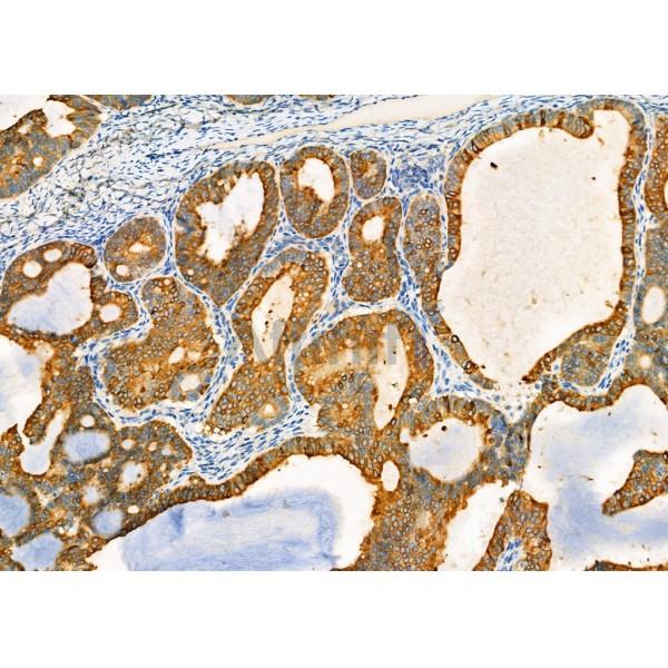 AGR2 Antibody - DF7855 at 1/100 staining Human ovarian cancer by IHC-P.