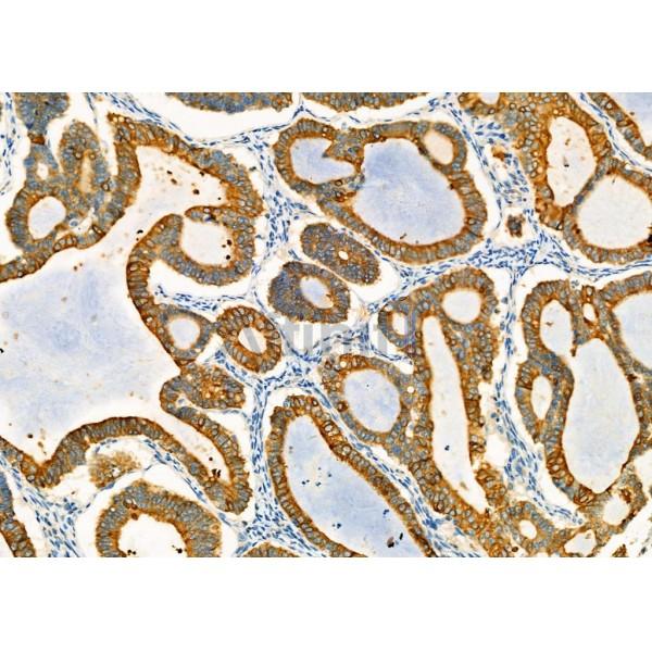 AGR2 Antibody - DF7855 at 1/100 staining Human ovarian cancer by IHC-P.