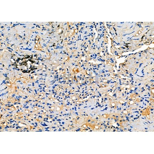 MUC16 Antibody - DF7989 at 1/100 staining Human lung cancer and adjacent normal tissues by IHC-P.