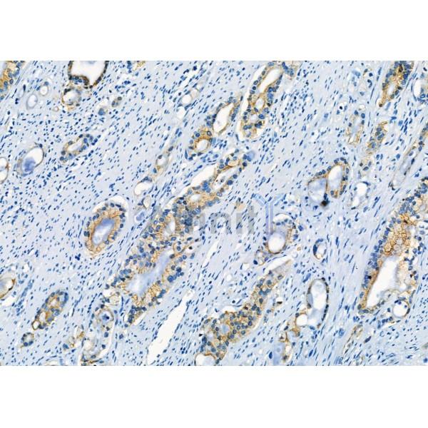 CLPP Antibody - DF8448 at 1/100 staining Human gastric cancer by IHC-P.
