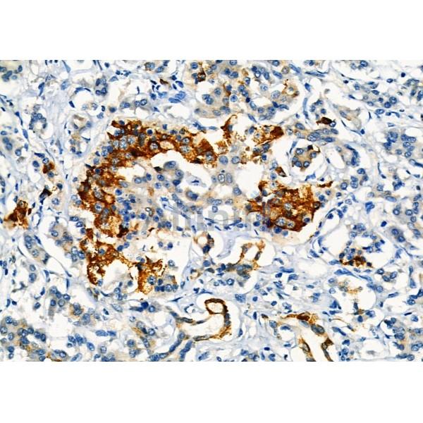 CLPP Antibody - DF8448 at 1/100 staining Human pancreatic cancer and adjacent nomal tissues by IHC-P.