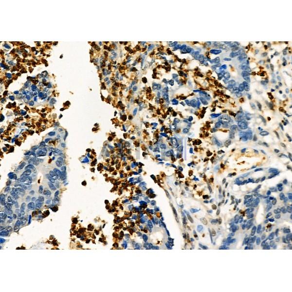 Fgl2 Antibody - DF8545 at 1/100 staining Human colorectal cancer by IHC-P.