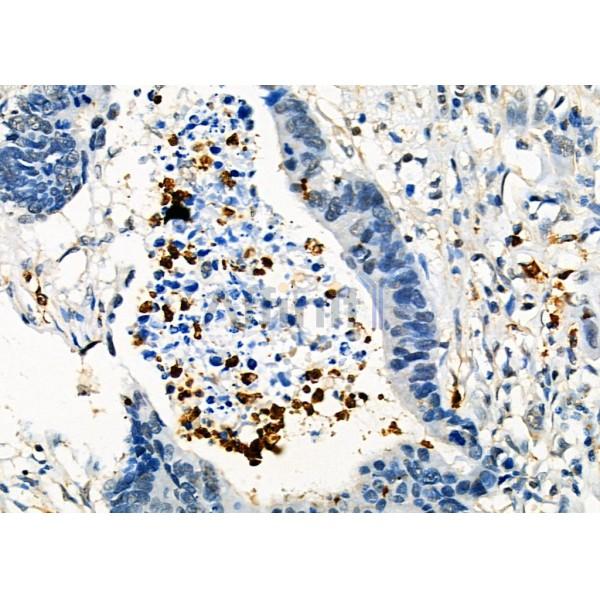 Fgl2 Antibody - DF8545 at 1/100 staining Human colorectal cancer by IHC-P.