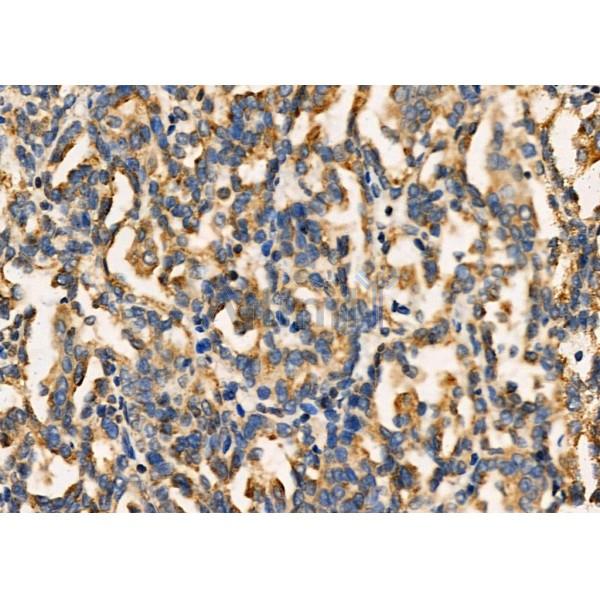 Inhibin beta C chain Antibody - DF8568 at 1/100 staining Human kidney cancer by IHC-P.