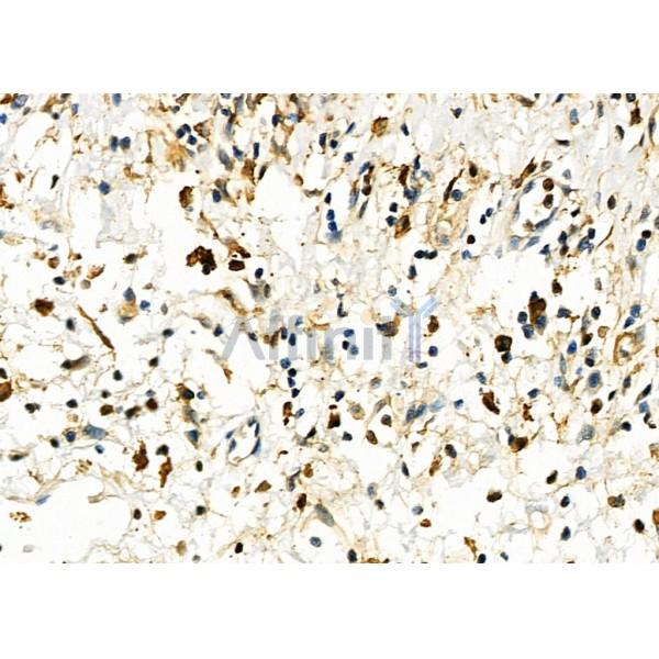 UCP2 Antibody - DF8626 at 1/100 staining Human esophageal cancer and adjacent normal tissues by IHC-P.
