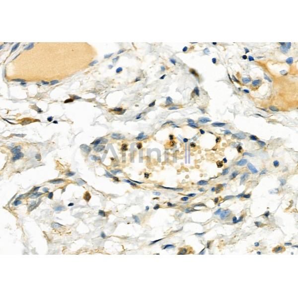 UCP2 Antibody - DF8626 at 1/100 staining Human colorectal cancer by IHC-P.