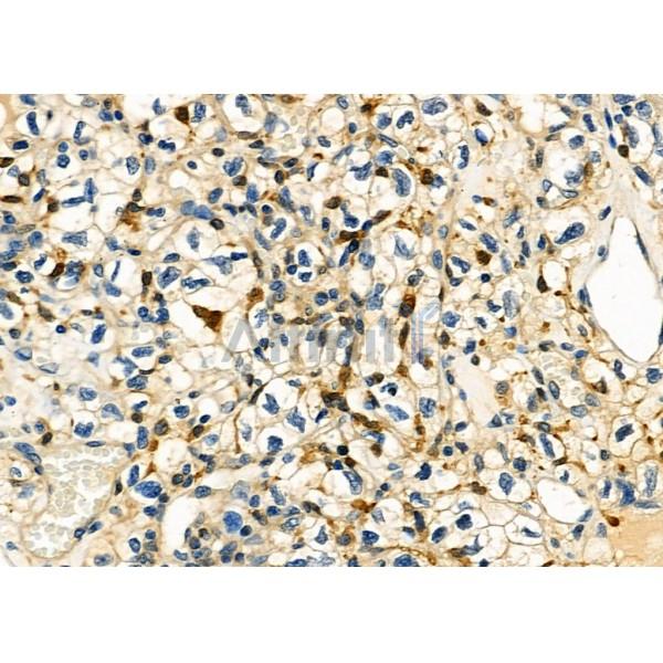 UCP2 Antibody - DF8626 at 1/100 staining Human kidney cancer by IHC-P.