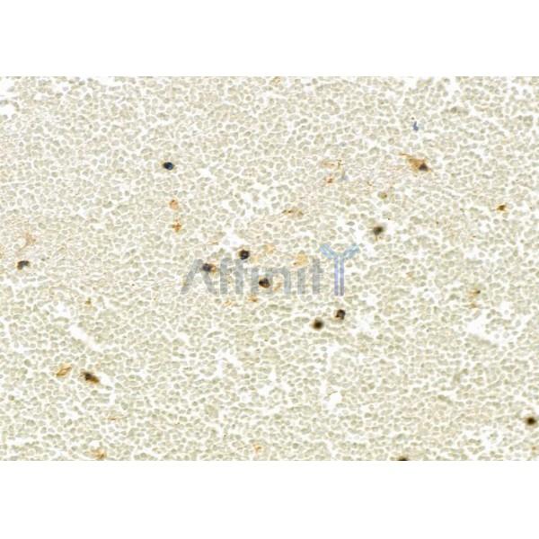 UCP2 Antibody - DF8626 at 1/100 staining Human kidney cancer by IHC-P.