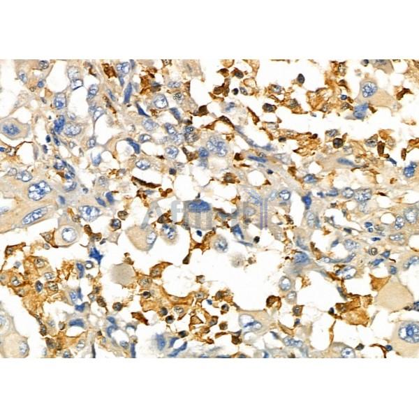 UCP2 Antibody - DF8626 at 1/100 staining Human lung cancer by IHC-P.
