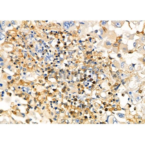 UCP2 Antibody - DF8626 at 1/100 staining Human lung cancer by IHC-P.
