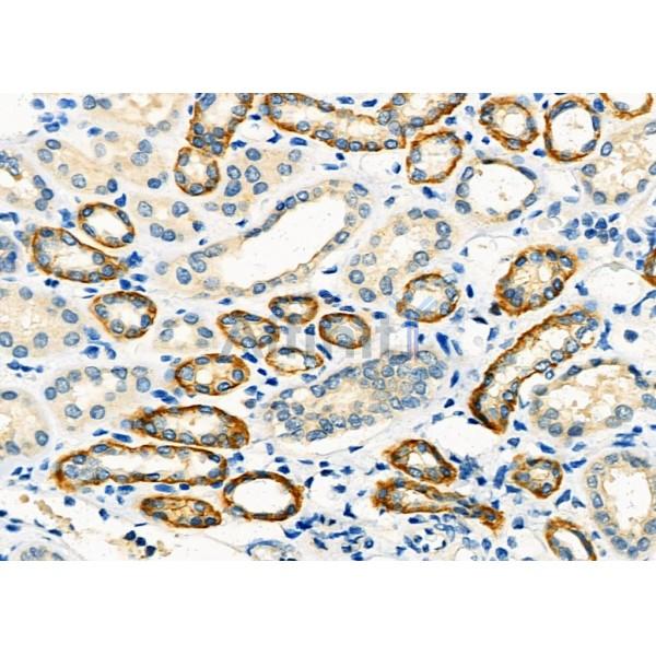 IGFL3 Antibody - DF8977 at 1/100 staining Human kidney cancer and adjacent normal tissues by IHC-P.