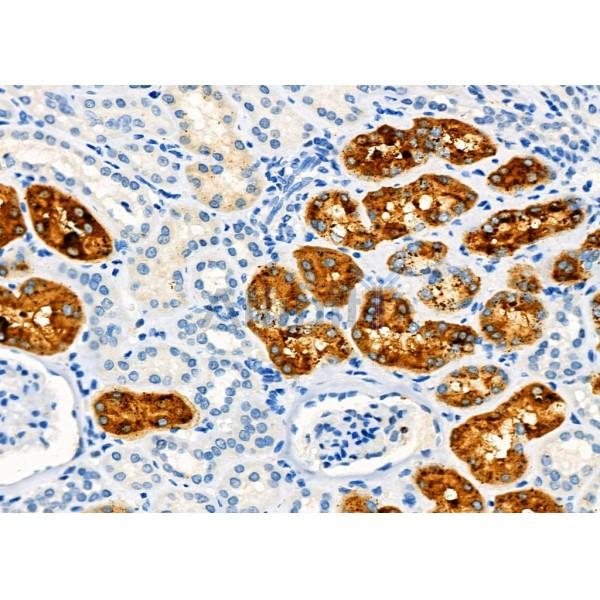 AQP11 Antibody - DF9222 at 1/100 staining Human kidney cancer and adjacent normal tissues by IHC-P.