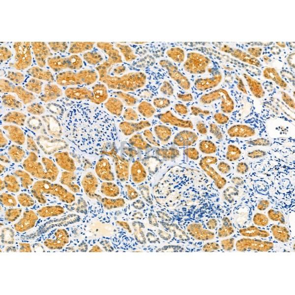 AQP9 Antibody - DF9225 at 1/100 staining Human kidney cancer and adjacent normal tissues by IHC-P.