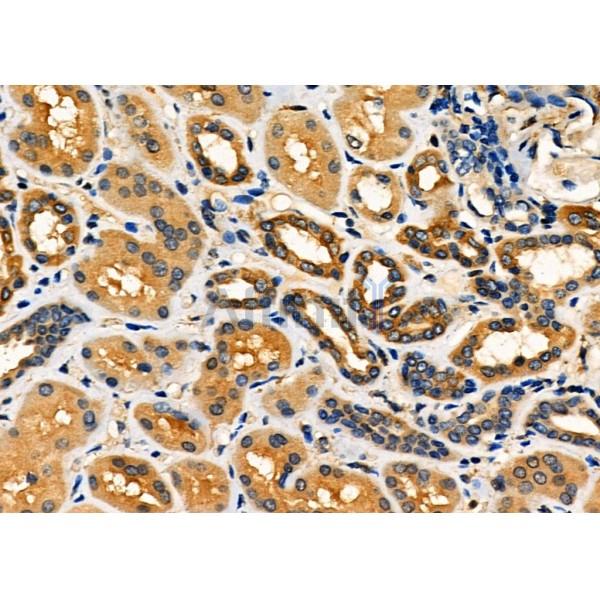 BMP1 Antibody - DF9280 at 1/100 staining Human kidney cancer and adjacent normal tissues by IHC-P.