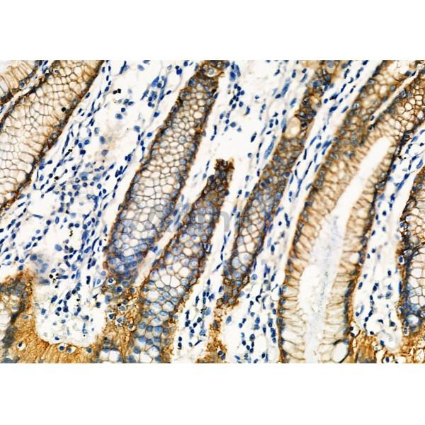 CLDN18 Antibody - DF9392 at 1/100 staining Human gastric cancer and adjacent normal tissues by IHC-P.