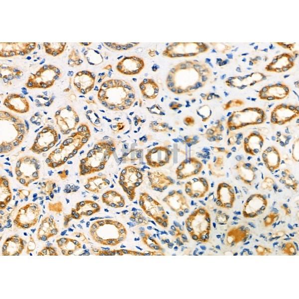 NXPH2 Antibody - DF9683 at 1/100 staining Human kidney cancer and adjacent normal tissues by IHC-P.
