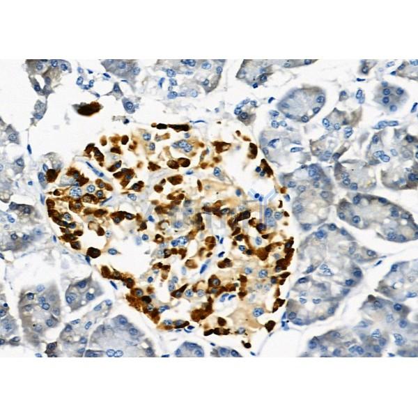 USP16 Antibody - DF9983 at 1/100 staining Human pancreatic cancer and adjacent nomal tissues by IHC-P.