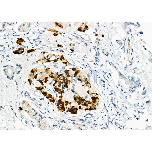 USP16 Antibody - DF9983 at 1/100 staining Human pancreatic cancer by IHC-P.