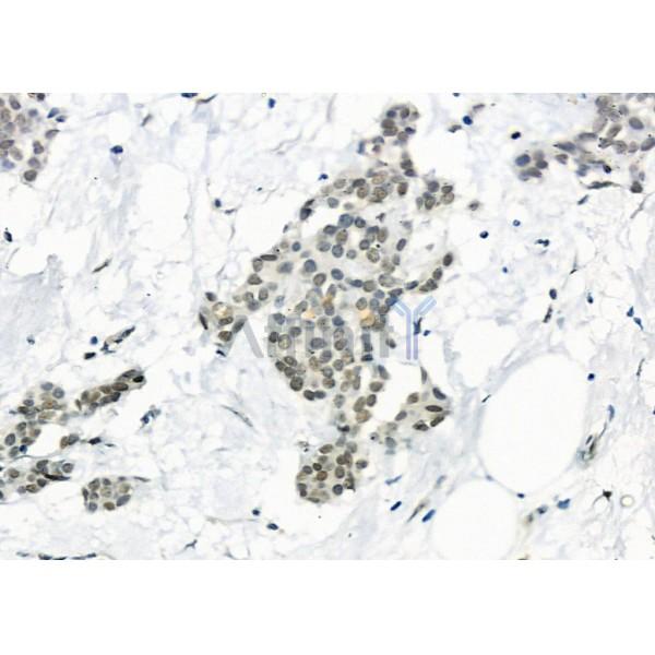 USP16 Antibody - DF9983 at 1/100 staining Human mammary cancer by IHC-P.