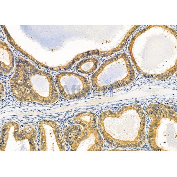Niban Antibody - AF4008 at 1/100 staining Human ovarian cancer by IHC-P.
