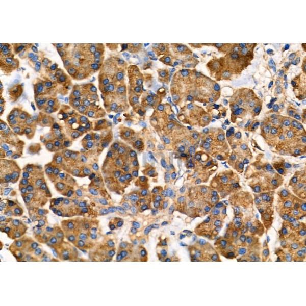 Arrdc1 Antibody - AF9016 at 1/100 staining Human pancreatic cancer and adjacent nomal tissues by IHC-P.