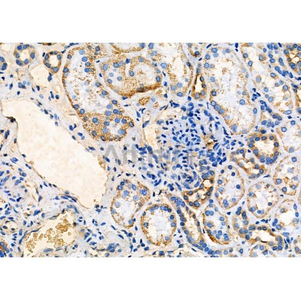 Arrdc1 Antibody - AF9016 at 1/100 staining Human kidney cancer and adjacent normal tissues by IHC-P.