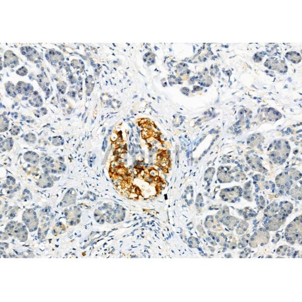 CD97 Antibody - DF2307 at 1/100 staining Human pancreatic cancer and adjacent nomal tissues by IHC-P.
