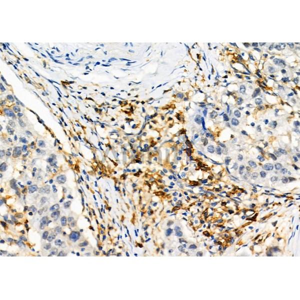CD97 Antibody - DF2307 at 1/100 staining Human pancreatic cancer by IHC-P.