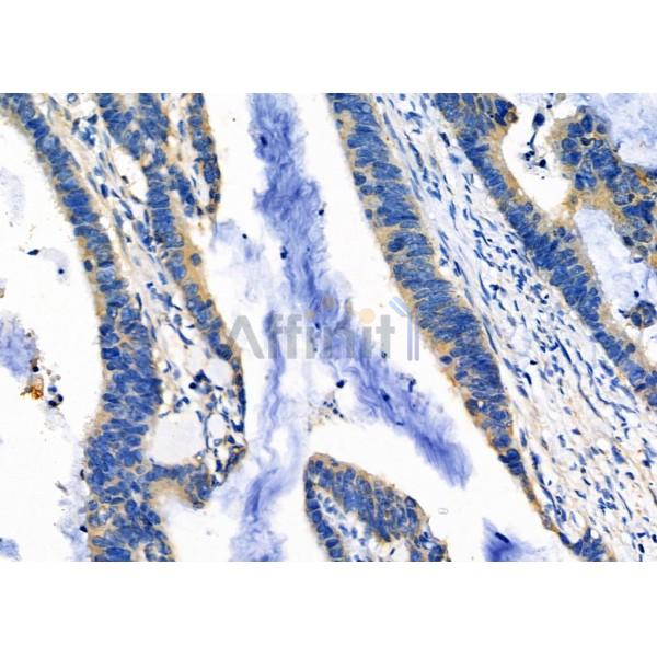DNAJC15 Antibody - DF2918 at 1/100 staining Human colorectal cancer by IHC-P.