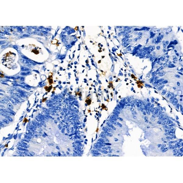 PTBP2 Antibody - DF2956 at 1/100 staining Human colorectal cancer by IHC-P.