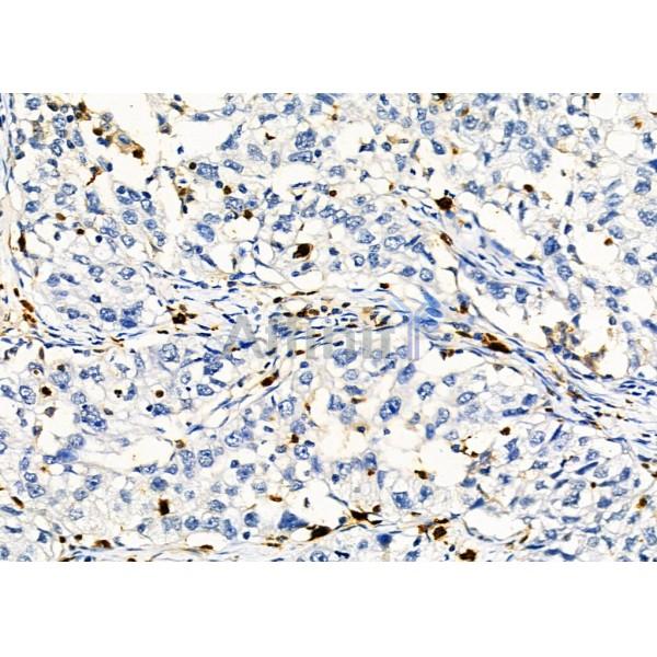PTBP2 Antibody - DF2956 at 1/100 staining Human pancreatic cancer by IHC-P.