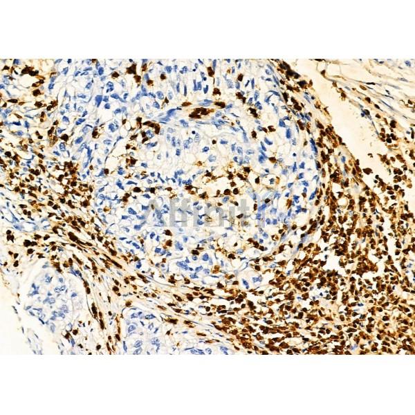 PTBP2 Antibody - DF2956 at 1/100 staining Human pancreatic cancer by IHC-P.