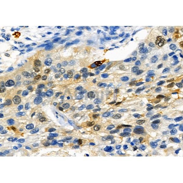 SATB2 Antibody - DF2962 at 1/100 staining Human esophageal cancer by IHC-P.