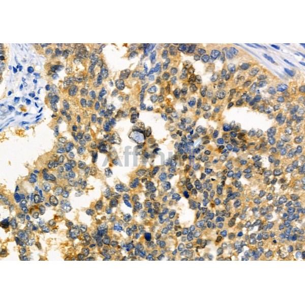 SATB2 Antibody - DF2962 at 1/100 staining Human ovarian cancer by IHC-P.