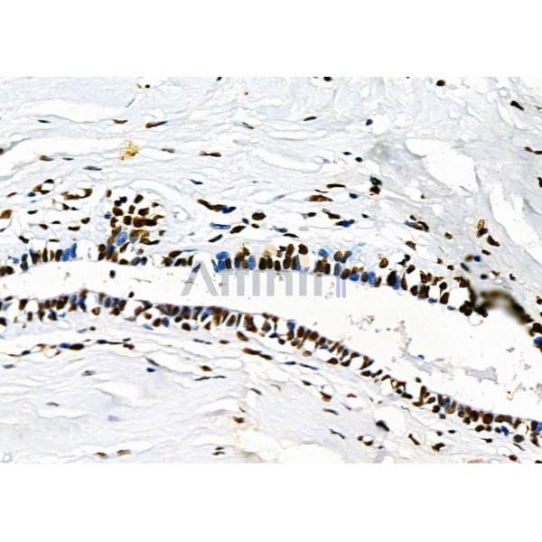 KAP1 Antibody - DF3150 at 1/100 staining Human mammary cancer and adjacent normal tissues by IHC-P.