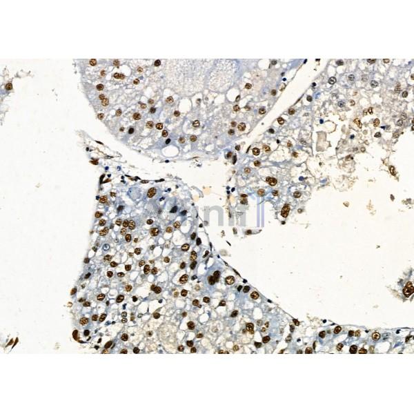 KAP1 Antibody - DF3150 at 1/100 staining Human prostate cancer and adjacent normal tissues by IHC-P.