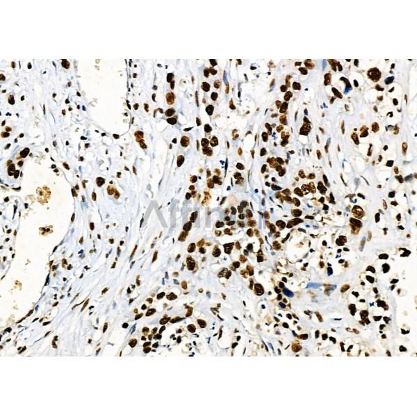 KAP1 Antibody - DF3150 at 1/100 staining Human gastric cancer by IHC-P.
