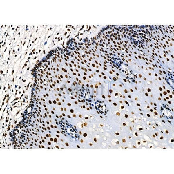 KAP1 Antibody - DF3150 at 1/100 staining Human esophageal cancer and adjacent normal tissues by IHC-P.