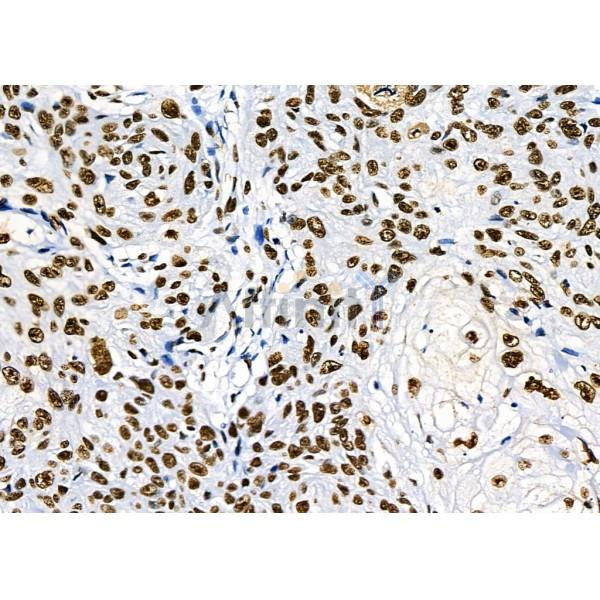 KAP1 Antibody - DF3150 at 1/100 staining Human esophageal cancer by IHC-P.