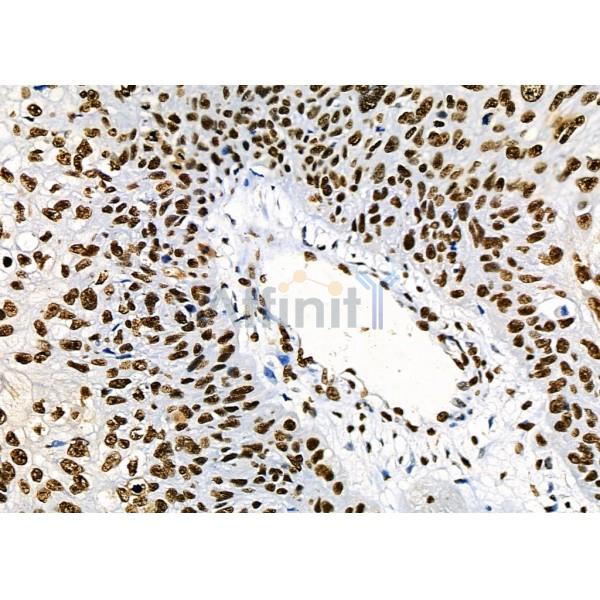 KAP1 Antibody - DF3150 at 1/100 staining Human colorectal cancer and adjacent normal tissues by IHC-P.