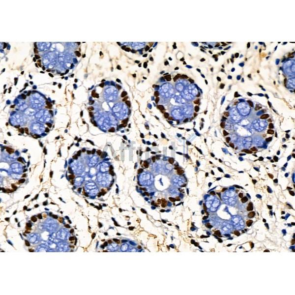 KAP1 Antibody - DF3150 at 1/100 staining Human colorectal cancer by IHC-P.