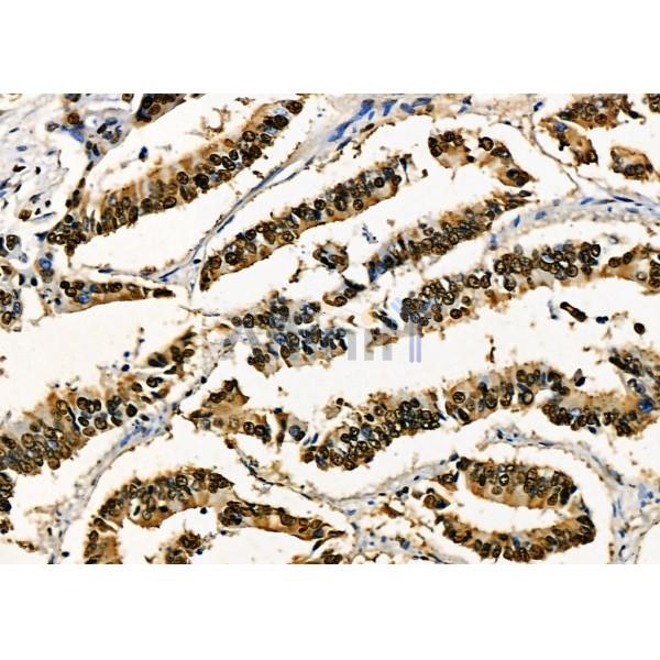 KAP1 Antibody - DF3150 at 1/100 staining Human colorectal cancer by IHC-P.