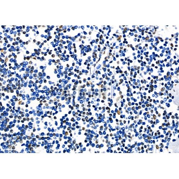 KAP1 Antibody - DF3150 at 1/100 staining Human mammary cancer by IHC-P.