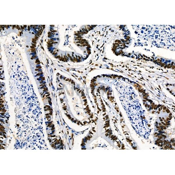 KAP1 Antibody - DF3150 at 1/100 staining Human prostate cancer by IHC-P.