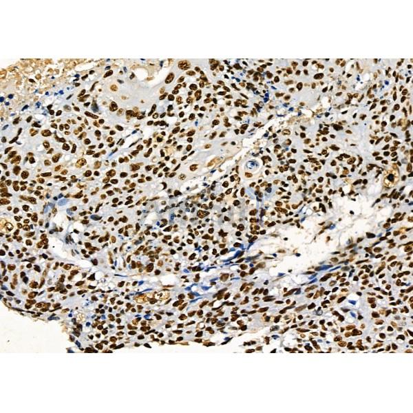 KAP1 Antibody - DF3150 at 1/100 staining Human pancreatic cancer by IHC-P.